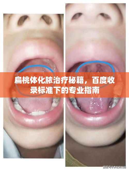 扁桃体化脓治疗秘籍,百度收录标准下的专业指南